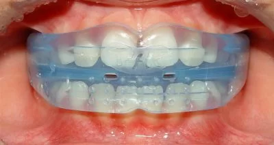 Preventieve orthodontie